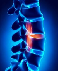 Des solutions pour l’hernie discale